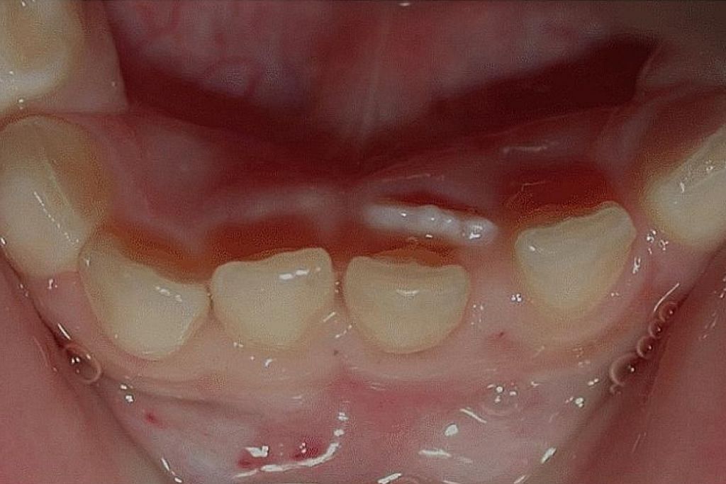 Usah bimbang jika gigi  susu  anak berlapis Berita Wacana 